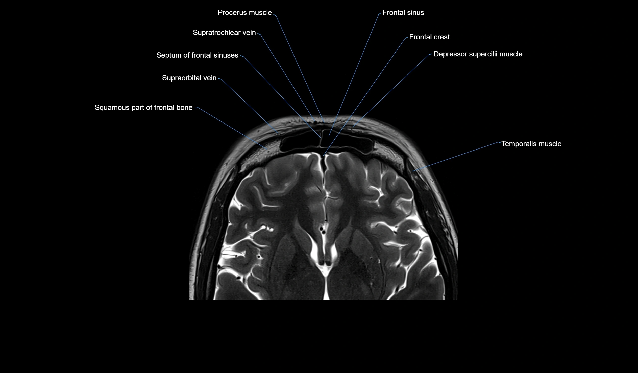 MRI face & paranasal sinuses(PNS) labelled  axial  cross sectional anatomy 3T radiology  image -00029.webp